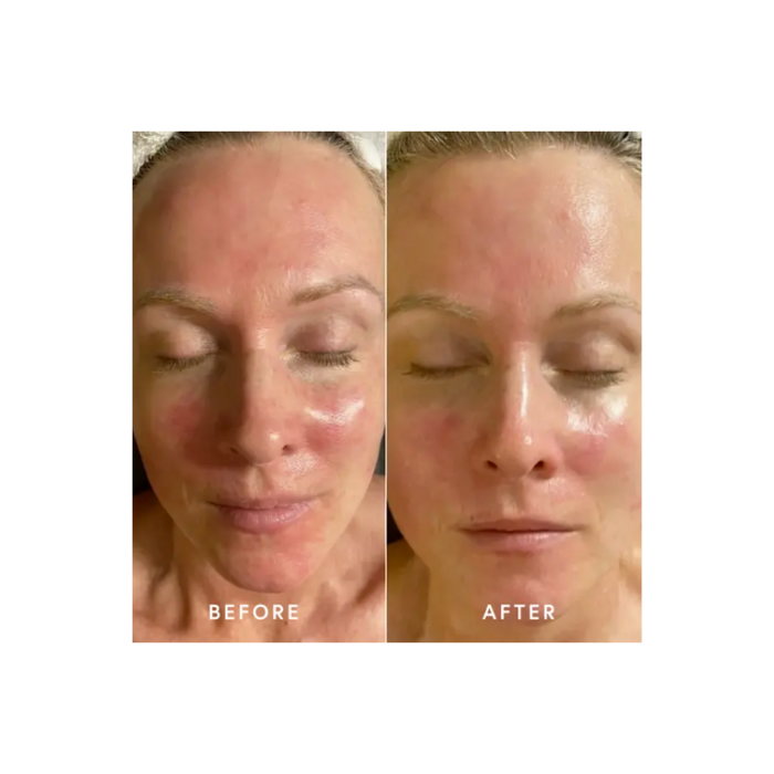 Epicutis Post Procedure Kit 3